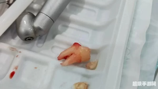 河南拔智齿